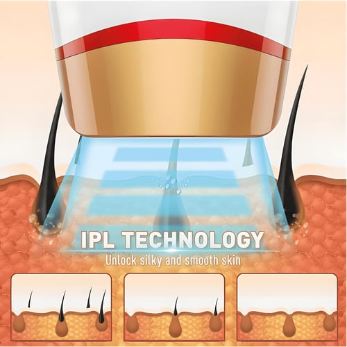 מכשיר הסרת שיער בלייזר נייד